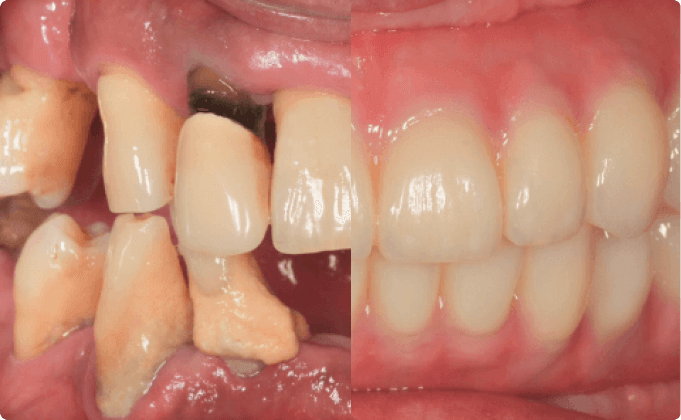 ホワイトニング