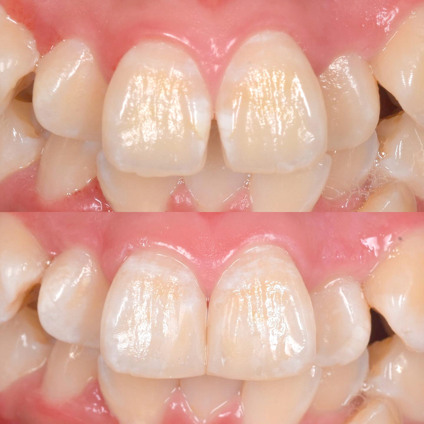 歯のすき間治療について