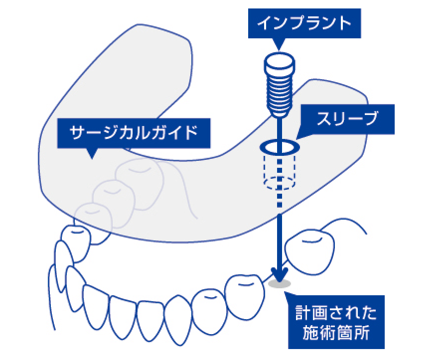 サージカルガイドを用いた、精密なインプラント治療