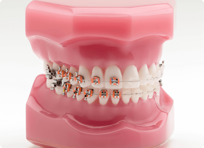 ワイヤー矯正イメージ