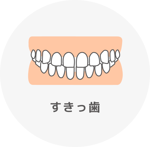 すきっ歯