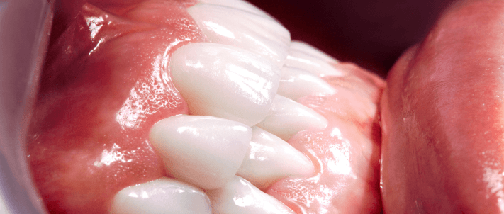 インプラントリカバリー