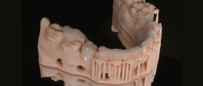 矯正 × インプラント