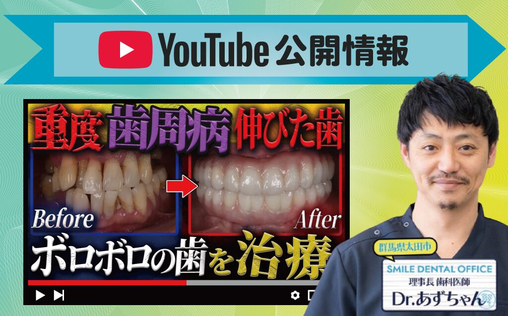 【YouTube動画】重度歯周病で歯が伸びてる＆抜け落ちてる患者をインプラントで治療！