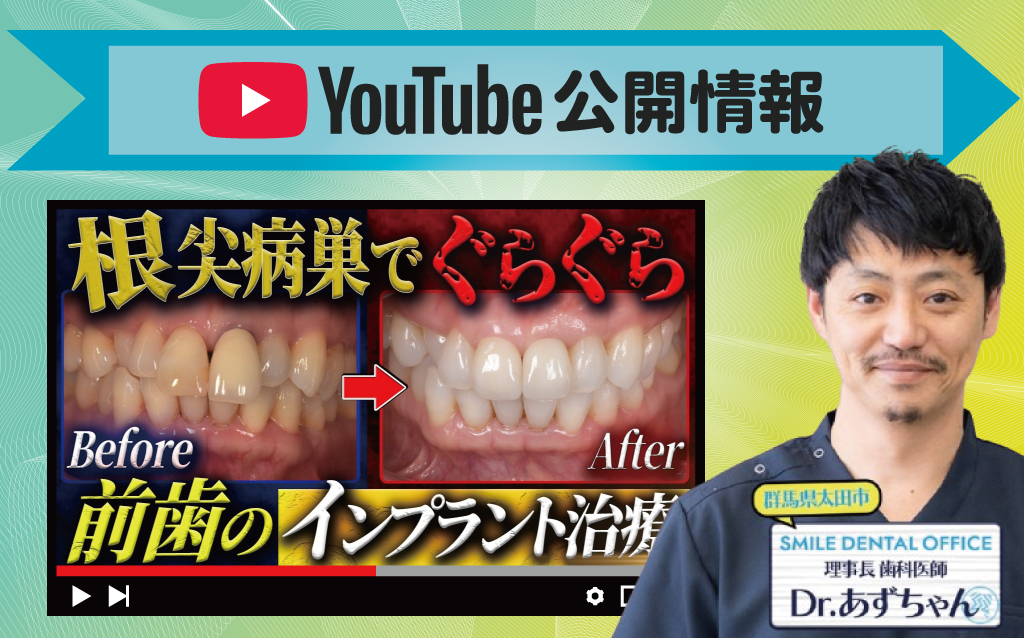 【YouTube】根尖病巣による前歯のインプラント治療症例