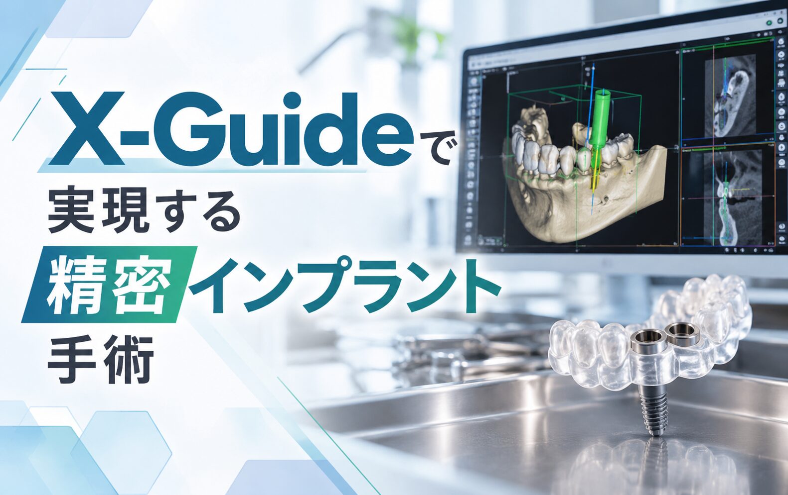 X-Guideで実現する精密インプラント手術