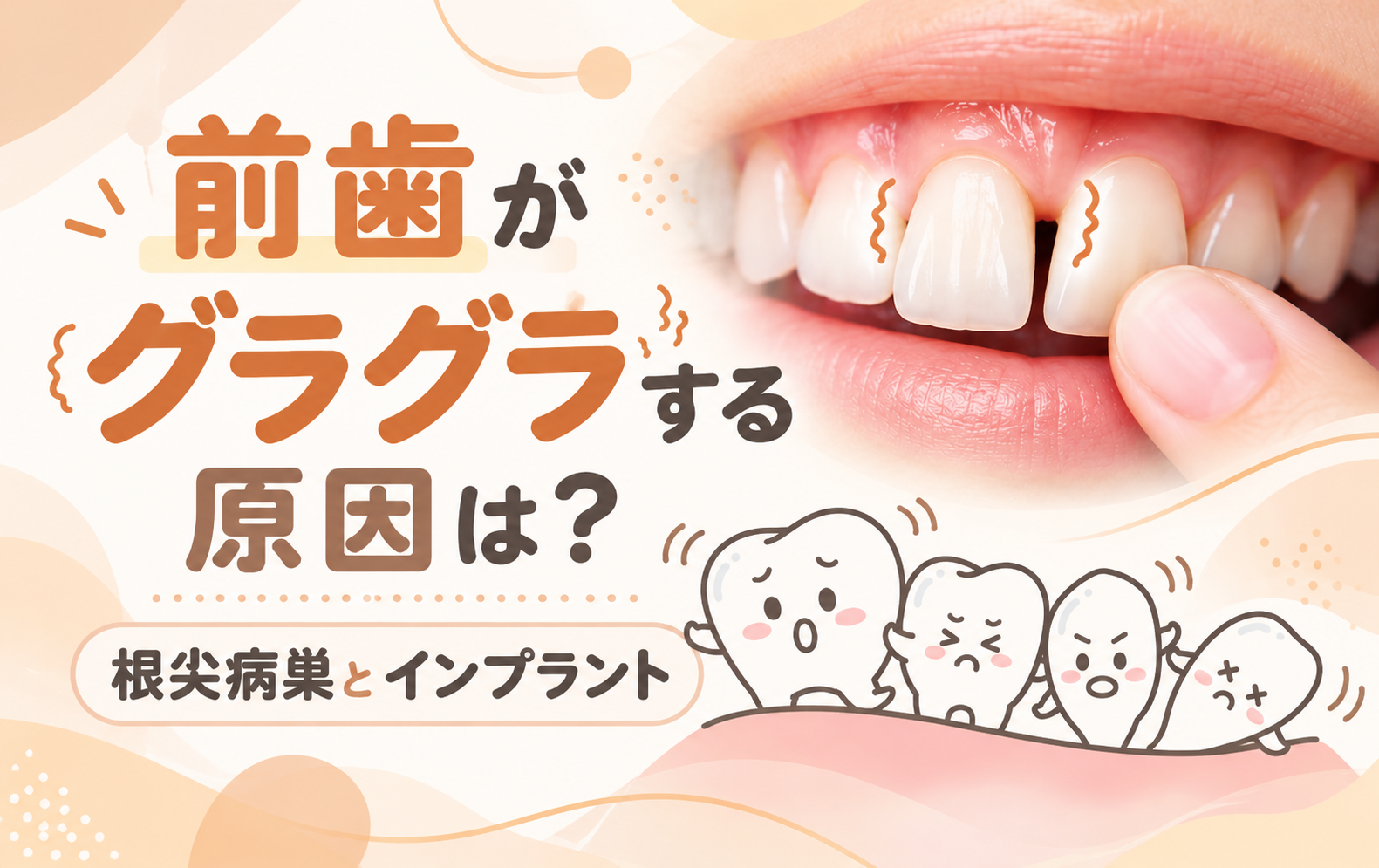 前歯がグラグラする原因は?根尖病巣とインプラント