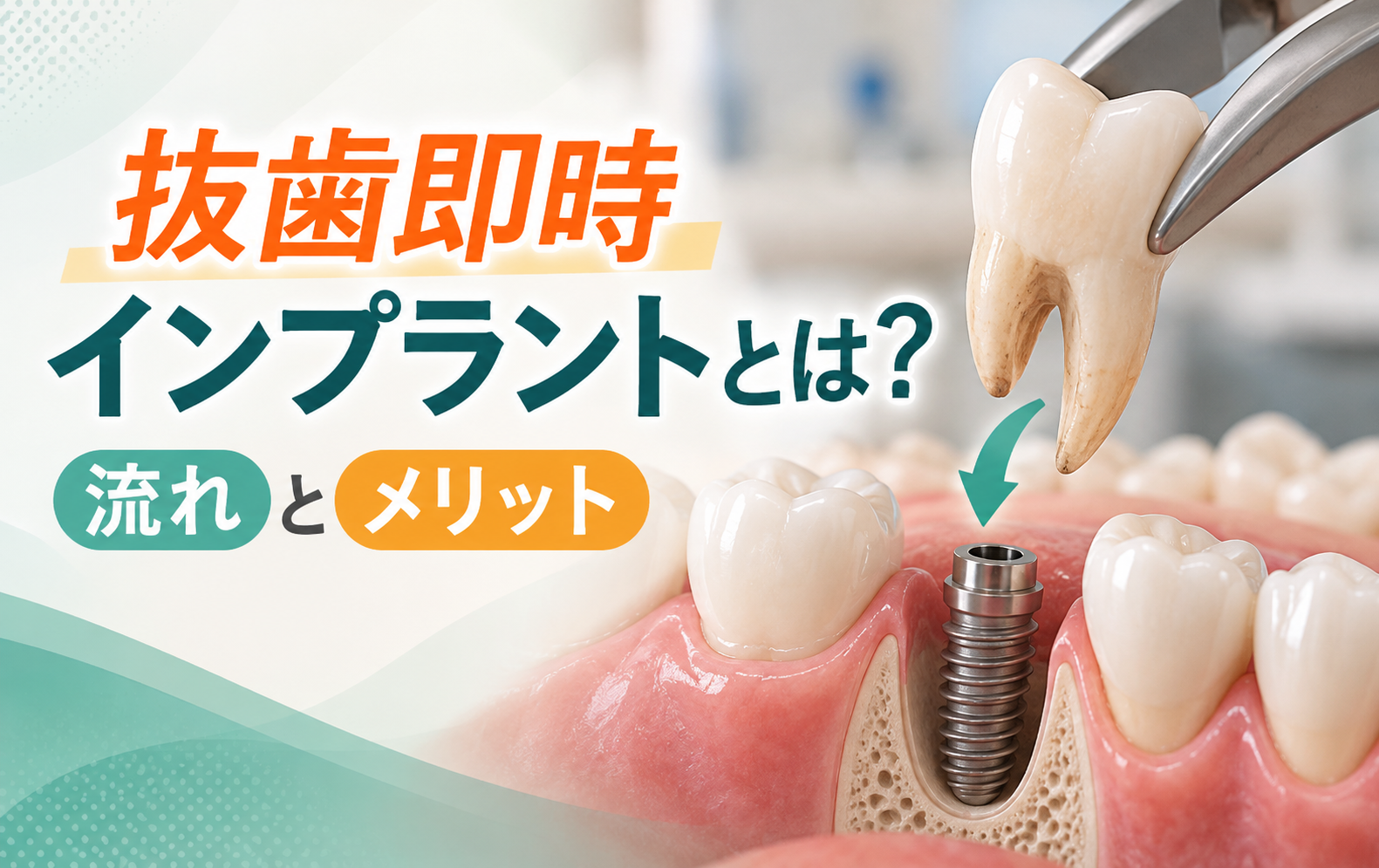 抜歯即時インプラントとは？流れとメリット