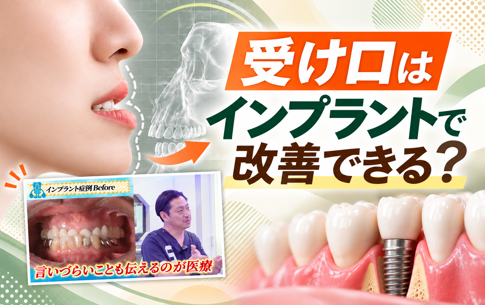 受け口はインプラントで改善できる?